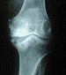 Artrosis de cadera tratamiento fisioterapeutico pdf descargar