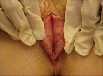 anus herpes images #10