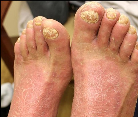 psoriasis nerviosa en los pies