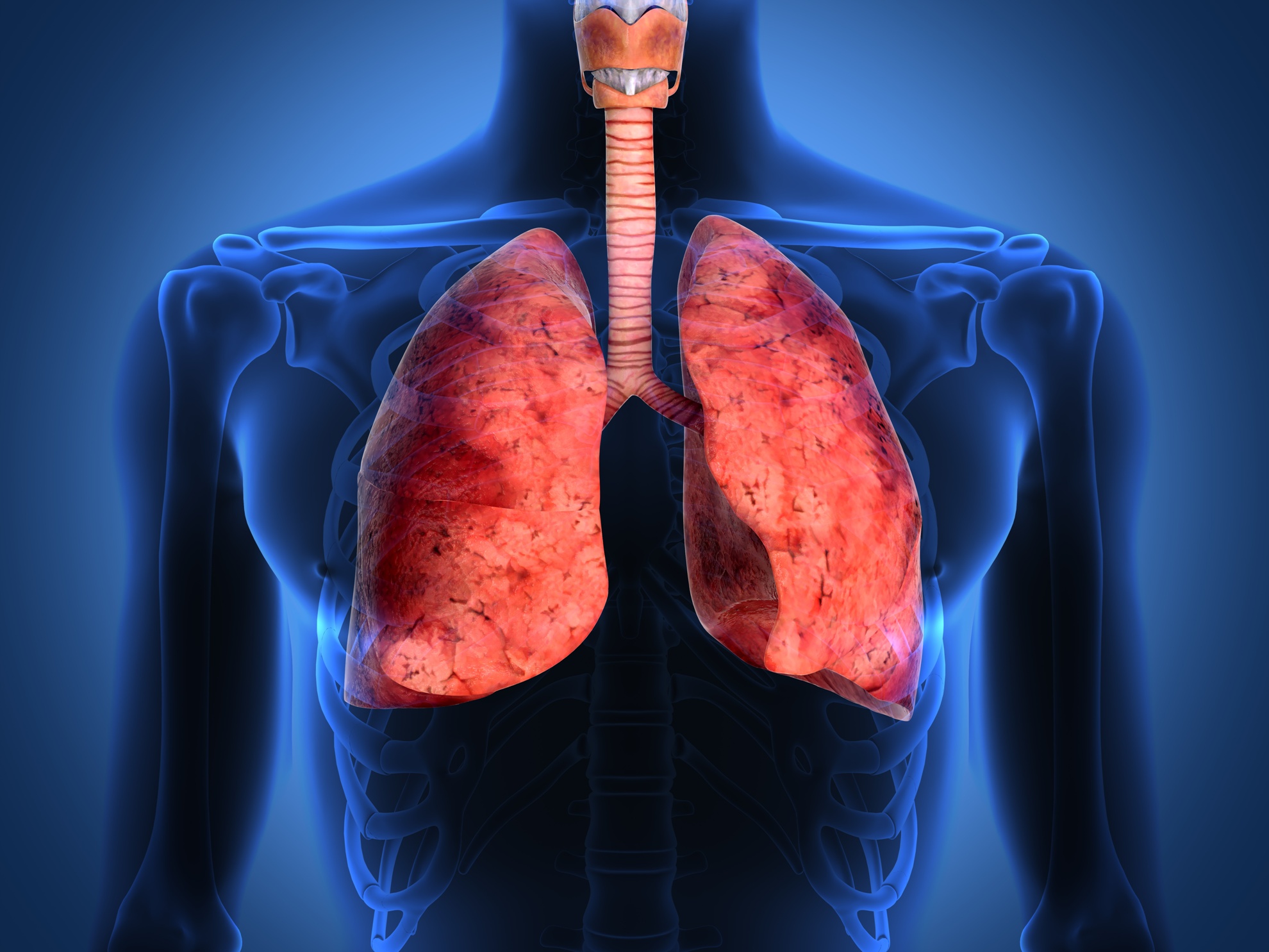 Cancer de pulmon neumonia