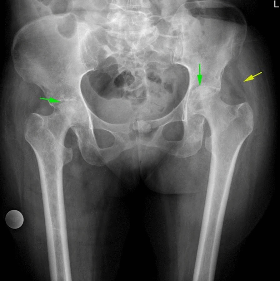 Los grados de la artrosis de rodilla - ITRAMED