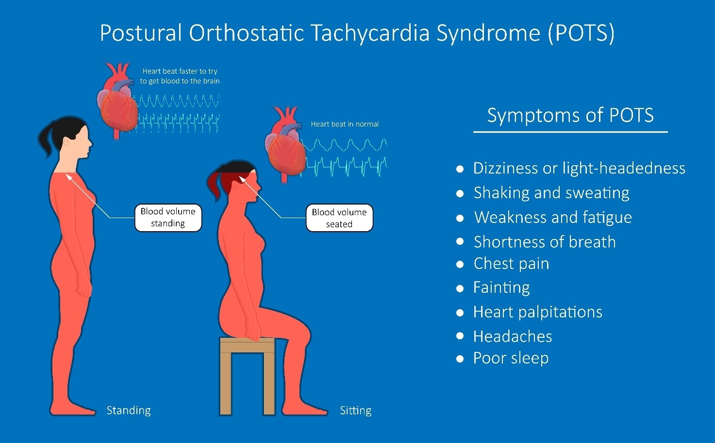 Síndrome de taquicardia postural ortostática - Noticias médicas - IntraMed