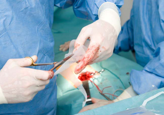 Prevención de eventración en cirugía abdominal abierta - Artículos - IntraMed