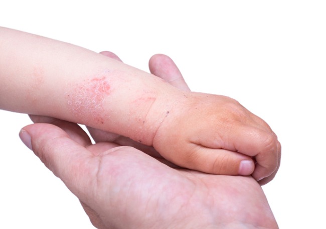 Dermatitis de contacto por al - Artículos - IntraMed
