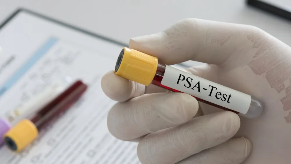 PSA para medir el cáncer de próstata
