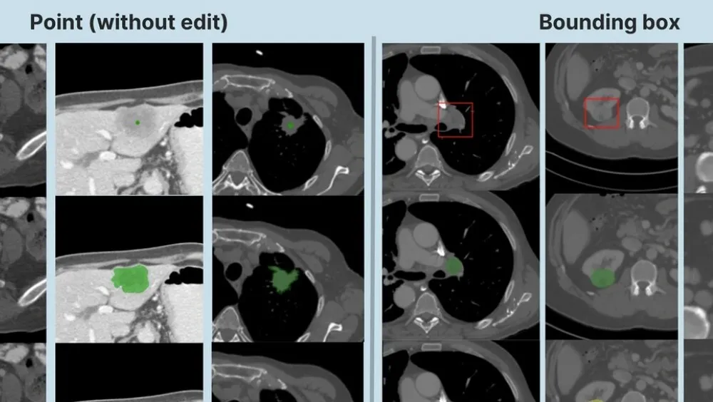 Sistema oncopiloto de IA para cáncer
