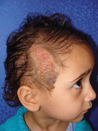 Prevalencia de enfermedades de cuero y perdida de pelo en niños - Artículos - IntraMed