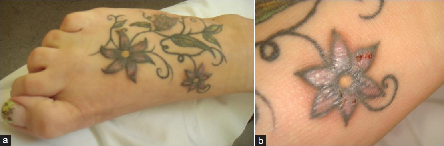 Eventos adversos severos relacionados con los tatuajes - Artículos - IntraMed